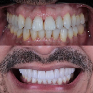 ANTES DEPOIS sorriso gerson front copy
